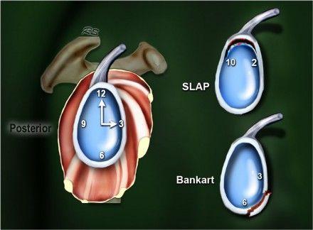 Labral Tears Slap Tear Bicep tendon pulls labrum off of glenoid Typically extends from 10 o clock to 2 o clock position Treatment: PT, anti-inflammatory drugs, termination of throwing activities,