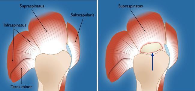 Rotator Cuff Tears Rotator cuff is made up of 4 muscles that act as tendons, covering the head of the humerus and helping to raise and rotate arm Most RC tears occur in supraspinatus tendon, but