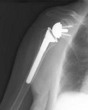 Reverse Total Shoulder Replacement Metal ball is attached to glenoid cavity and socket is attached to humeral head Allows for usage of