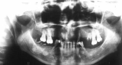 Samalavicius NE Figure 2: Multiple mandibular osteomas seen on orthopantomography in a 24 year old male FAP patient. Gastroduodenal polyps.
