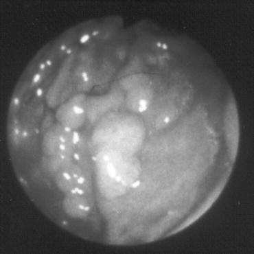 8%) patient gastric adenoma was detected and endoscopically removed. The number of gastric adenomas was compared to findings in 3,700 controls, where in 42 (1.
