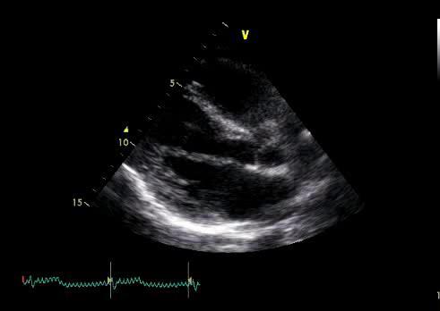 RR tenderness over the left hemiabdomen and hyperperistalsis normal cardiac and pulmonary auscultation