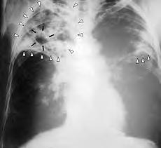 Diagnosis Active TB: radiology
