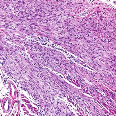 This pattern is commonly seen in schwannoma and MPNST.