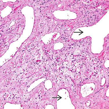 characteristically feature a conspicuous collagenous stroma that may or may not show prominent hyalinization or dense sclerosis.