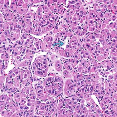 Pattern-Based Approach to Diagnosis (Left) Nested or lobular patterns are common in epithelioid neoplasms.