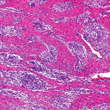 tissue tumors feature a mixture of spindled and epithelioid tumor cells, either as discrete components or closely admixed.
