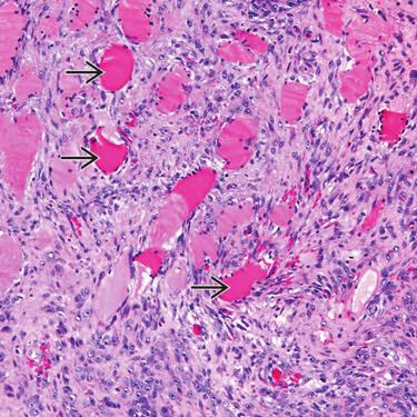 (Right) Plexiform fibrohistiocytic tumor is a neoplasm that may feature predominantly spindled cells in bundles/fascicles,