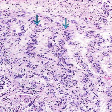 Checkerboard Skeletal Muscle Pattern Nuclear Palisading (Left) Although any intramuscular neoplasm can show infiltration of normal