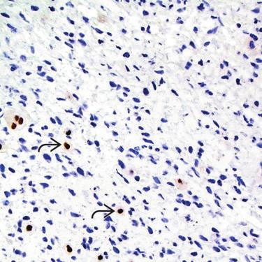 Post-Therapy Changes Immunohistochemistry (Left) If a specific diagnosis is not established prior to neoadjuvant therapy, definitive classification