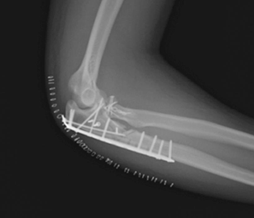 A -hole periarticular plate was utilised for fixation of the fracture of the proximal ulna. The accompanying fracture of the head of the radius was treated with a mini-t plate.