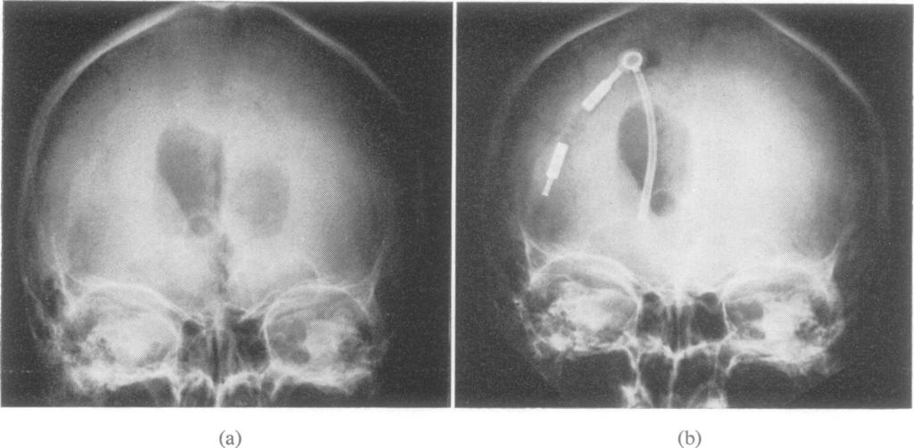 836 Henry A. Shenkin, Jack 0. Greenberg, and Charles B. Grossman FIG. 2 F.S., remarkable clinical recovery postoperatively. (a) Pneumoencephalogram, anteroposterior view preoperatively.