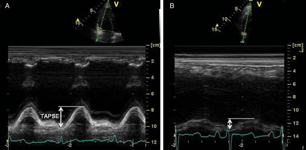 TAPSE: Tricuspid Annular Plane Systolic Excursion Contraction of the RV is mainly longitudinal, and the tricuspid annulus displaces toward apex during systole Imaging through lateral RV