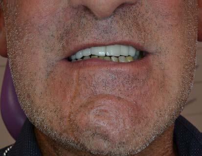 Multiple teeth Bridgework on implants to replace multiple teeth Full arch