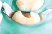 teeth with composite for more than 30 years and thought I d demonstrate some