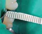 Anterior Cantilever Premier cure through contoured matrix held in place by