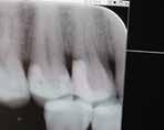 n I don t see any separating ring, i.e., bitine, V-ring. Are you achieving these nice-looking contacts with just a wedge and a contoured matrix? n Those all look like endodontic time bombs!