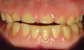 We all have placed temporaries and gone back in a month or two later and been amazed how hard some of the affected (was soft at the initial appointment) dentin is.