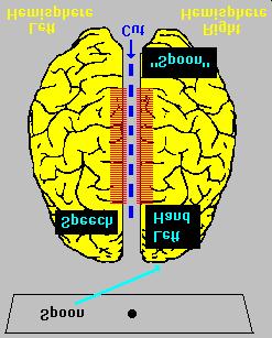 Página 3 de 5 this surgical operation isolates most of the right hemisphere from the left hemisphere. This type of surgery is performed in patients suffering from epilepsy.
