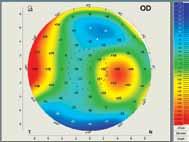 The Bochner Eye Institute established the first Keratoconus Clinic in Canada in 2008. The consultation and advanced imaging are OHIP covered.