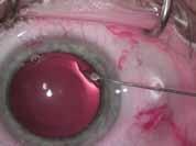 Phakic Intraocular Implants a phakic implant such as a Toric Implantable Contact Lens can be inserted behind the iris and in front of the crystalline lens to correct a high degree of myopia and