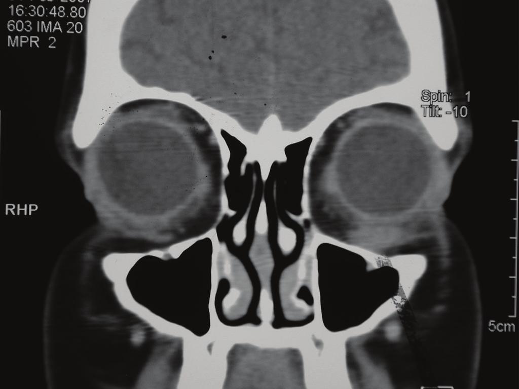 2 Figure 1: Coronal computerised tomography scan showing diﬀuse swelling of the left inferior oblique muscle.