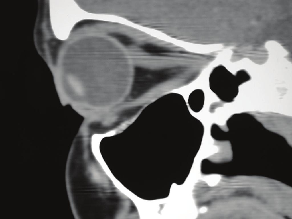 Figure 2: Parasagittal view showing normal right orbital contents.