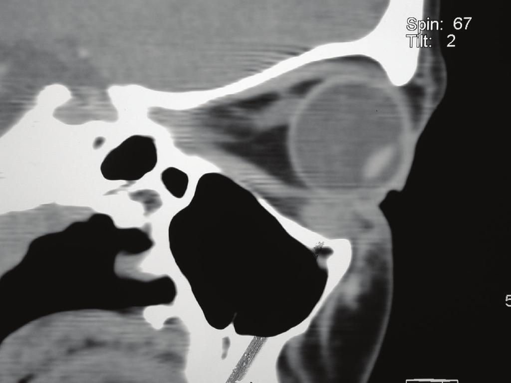 orbital sarcoid, although CT chest and ongoing followup have excluded systemic sarcoidosis. Figure 3: Parasagittal view showing swelling in left inferior oblique.