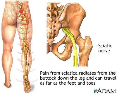 sciatic nerve).
