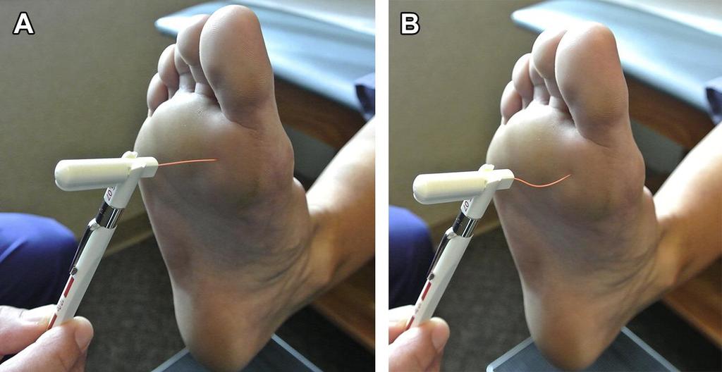 Fig. 2 Demonstration of the assessment of peripheral neuropathy using the Semmes- Weinstein monofilament: ( A ) depicts application of the monofilament, ( B ) demonstrates the bend