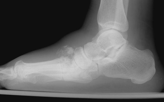Midfoot (type I) Clinical most common(70%) collapse : rocker