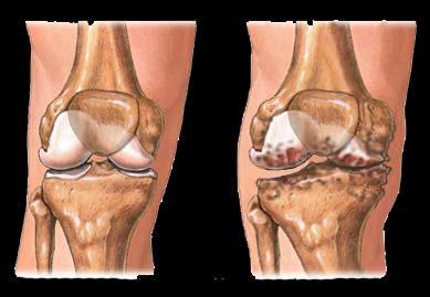 The patella, commonly referred to as the knee cap, rides on the knee joint and offers protection as the knee bends, straightens and rotates.