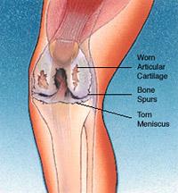 Reasons for Knee