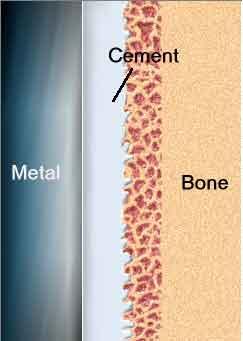 Fundamentals General idea is to replace the diseased surface with one made of a synthetic material Joint is interfaced with the bone using one of two methods; PMMA