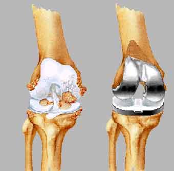 Four Components of a Knee Replacement 1. Femoral component 2. Tibial component 3. Plastic insert 4.