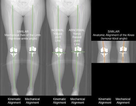 Alignment The effectiveness of a knee replacement greatly depends on having the proper alignment of the components, to