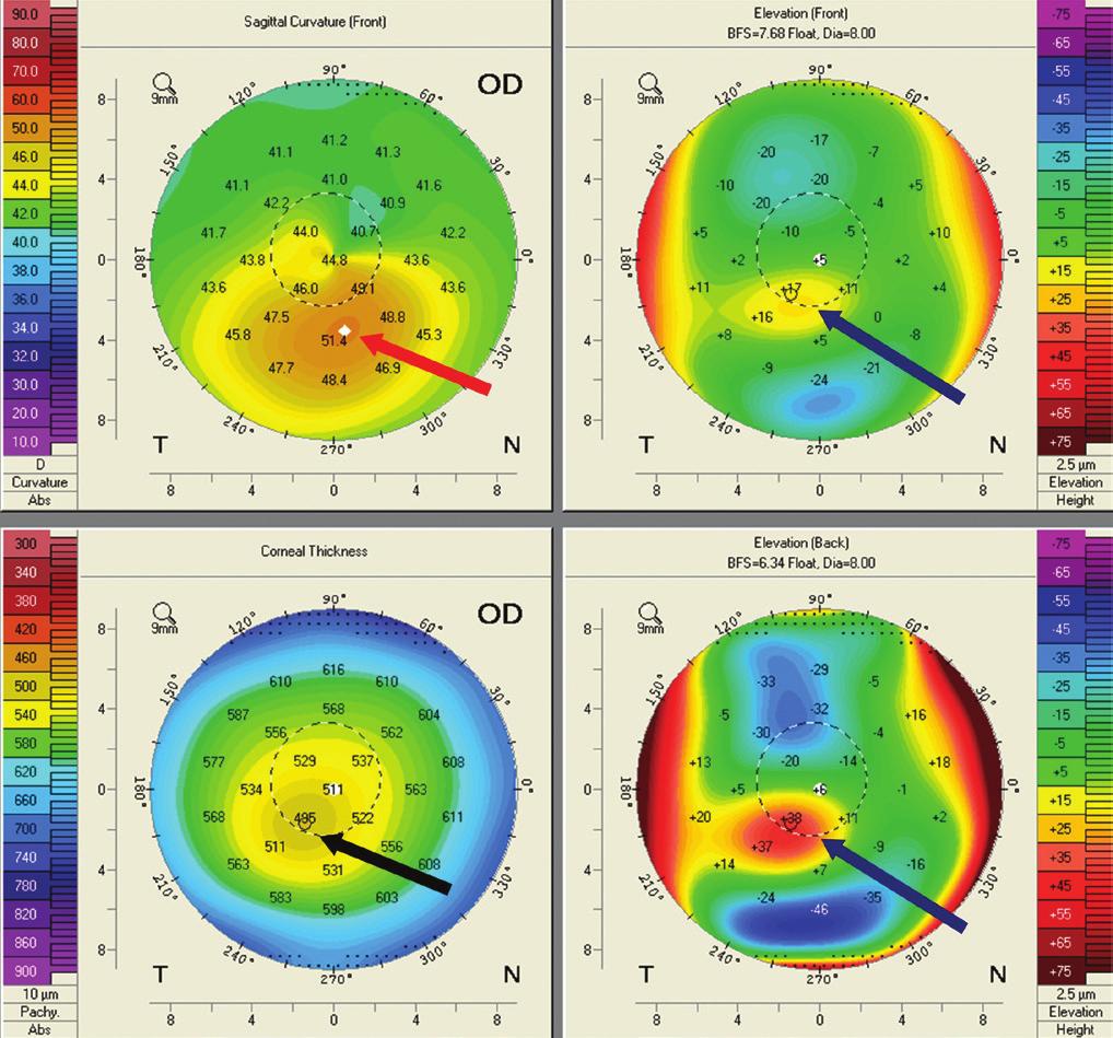 1 CET POINT CET CONTINUING 40 Corneal topography and tomography Standard automated keratometry assesses corneal curvature by measuring four data points over the central 3-4mm of the cornea.