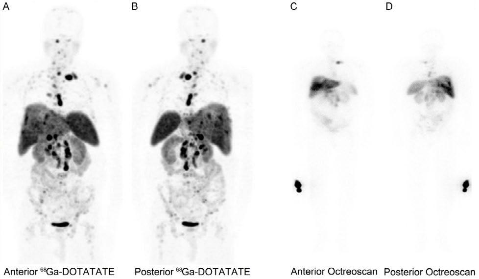 Imaging and endoscopic techniques to diagnose and monitor NET CT 23-25 OCTREOSCAN (SRS) 24-26 Figure 1.