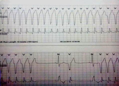 bradycardia (Heart rate 37 beats per minute) with blood pressure of 100/70 mmhg.