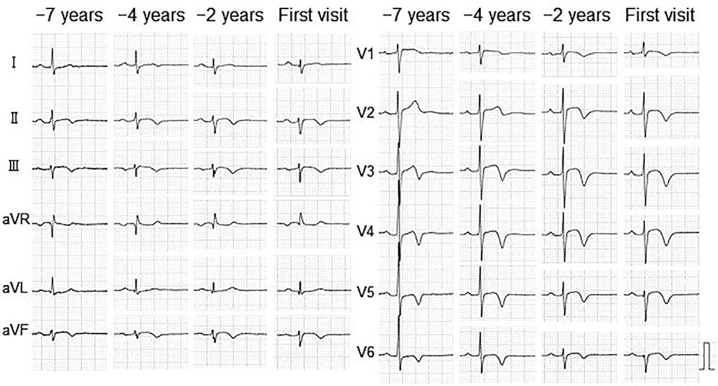 Serial resting 12-lead electrocardiograms (ECGs). Seven years before the first visit to our hospital (-7 years), ECG showed normal QRS voltage and normal R wave progression in the precordial leads.