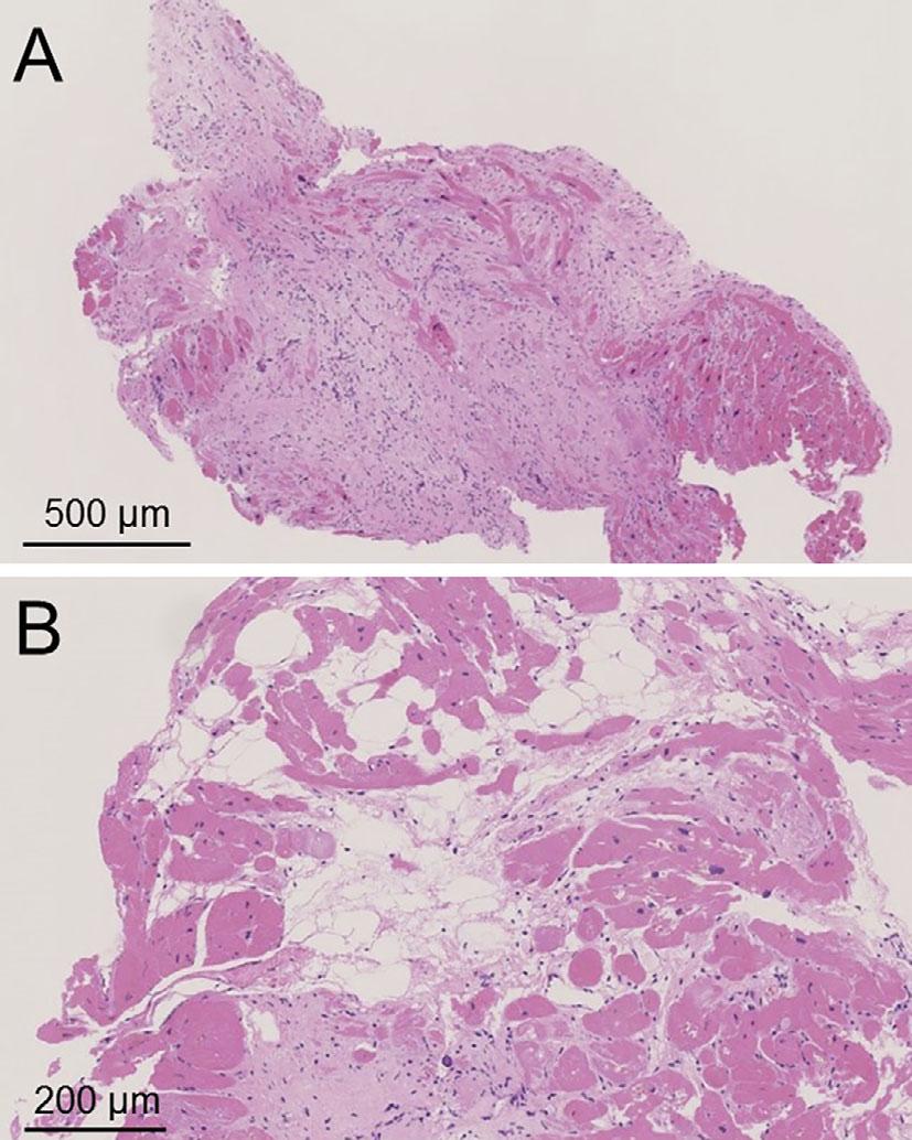 Figure 5. Histological images of the endomyocardial biopsy materials obtained from the right ventricular side of the interventricular septum (Hematoxylin and Eosin staining).