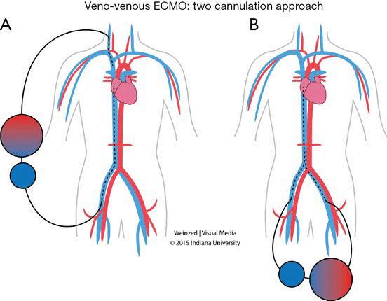 VV CANNULATION VA ECMO INDICATIONS CARDIAC FAILURE - Post-cardiotomy - Unable to get patient off cardiopulmonary bypass following cardiac surgery - High