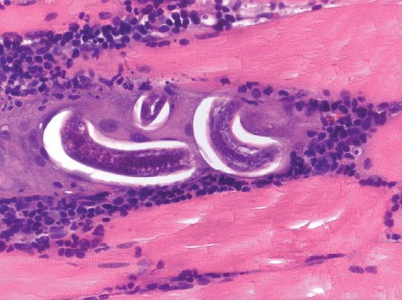 Figure 2. Trichinella larvae encysted in sartorius muscle of index patient (hematoxylin and eosin stain, magnification 40 ).