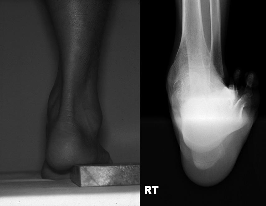 Dynamic Pedobarography after Extensive Plantarmedial Release for Paralytic Pes Cavovarus surgical technique appropriate for the cause of disease, age at the time of surgery, and especially the