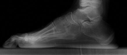 Dynamic Pedobarography after Extensive Plantarmedial Release for Paralytic Pes Cavovarus ed measurements from individual patients and was adjusted for intra-person correlations.