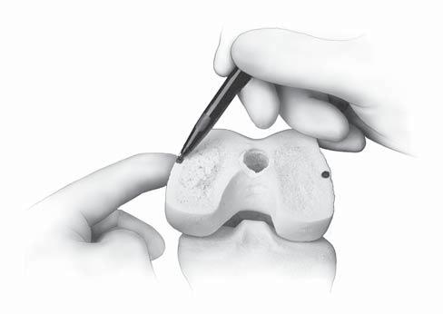 Optional Technique: Another method of setting external rotation is to identify the epicondylar axis. To identify the lateral epicondyle, it is necessary to dissect away the patellofemoral ligament.