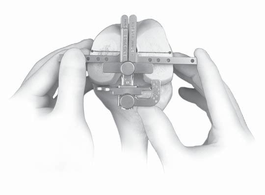 Set the rotation of the epicondylar guide parallel to the epicondylar axis. Read the angle of external rotation indicaterd by the Poseterior Reference/Rotation Guide.