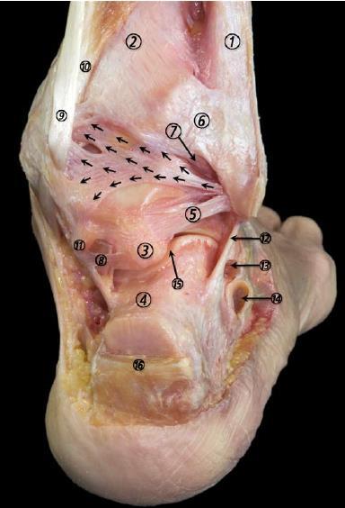 Lateral collateral ligament Posterior talofibular ligament (5) Fibula (1) Tibia (2) Proc. tali, tuberculum laterale (3) Proc.