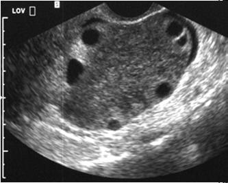5% Up to 3/4 cases US may demonstrate multiple small uniform cysts aligned in the periphery