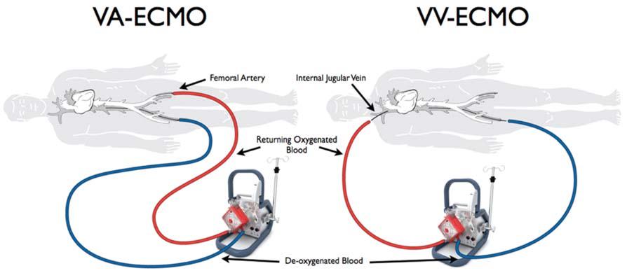 Interhospital Transport of the ECMO Patients in Bangkok Hospital Figure 1: Type of ECMO; (1) Veno-Arterial (VA) ECMO, (2) Veno-Venous (VV) ECMO (Cardiohelp, Maquet).